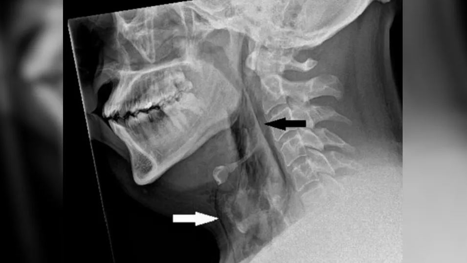 Рентген шеи мужчины показал наличие воздушных карманов под кожей шеи, как показано стрелками. (Изображение предоставлено: BMJ Case Reports 2023)