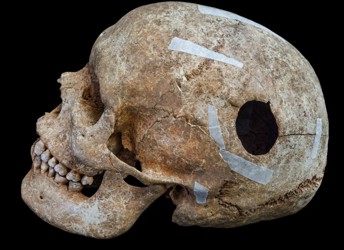 Череп молодого мужчины (17–24 лет) с овальным отверстием диаметром 3 см. Ученые предполагают, что трепанация могла быть попыткой облегчить головные боли, вызванные внутричерепным давлением из-за опухоли гипофиза. Фото: Кембриджский археологический отдел / Дэвид Мацлиах. Опубликовано 4 февраля 2026 года.